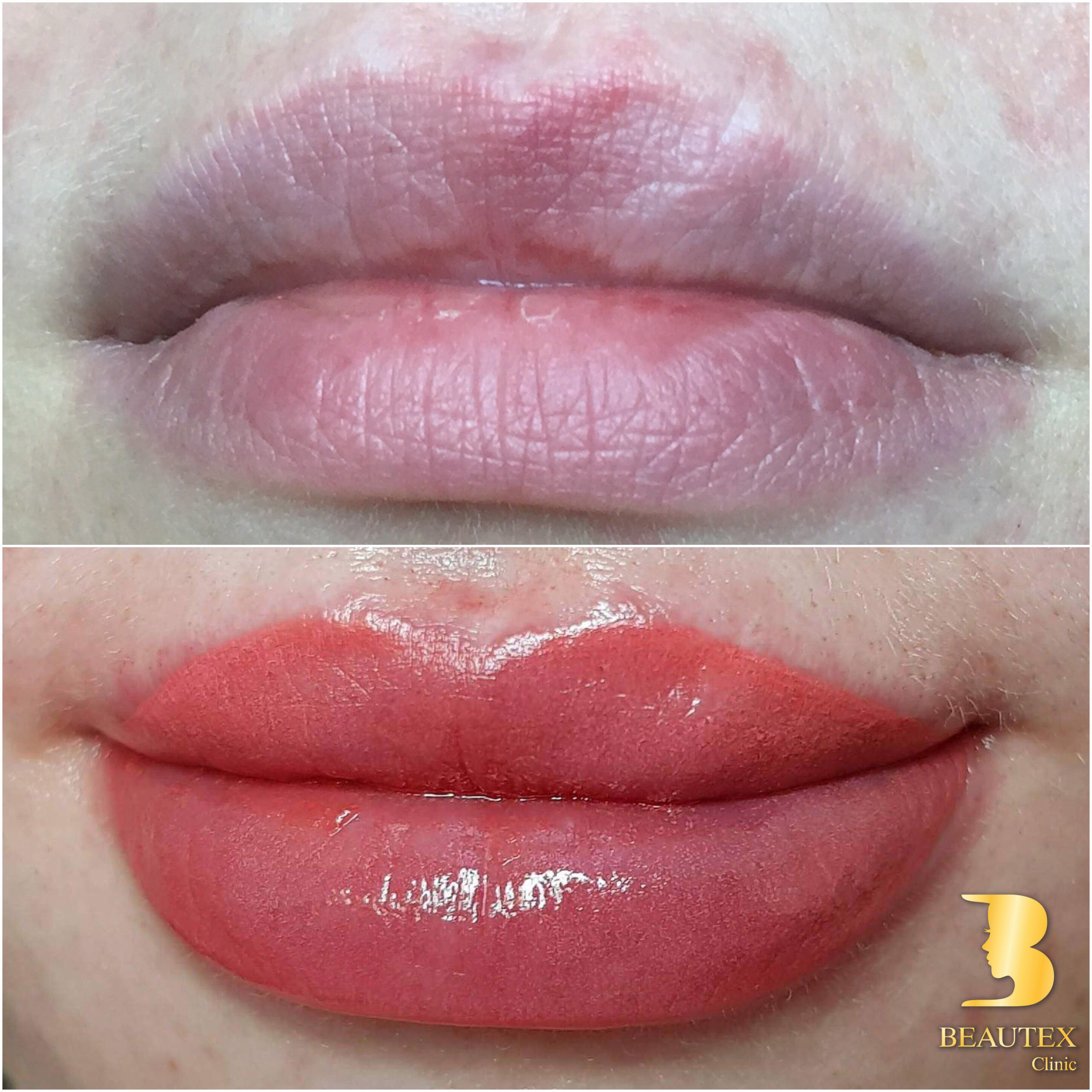 A woman's lips before and after lip filler.