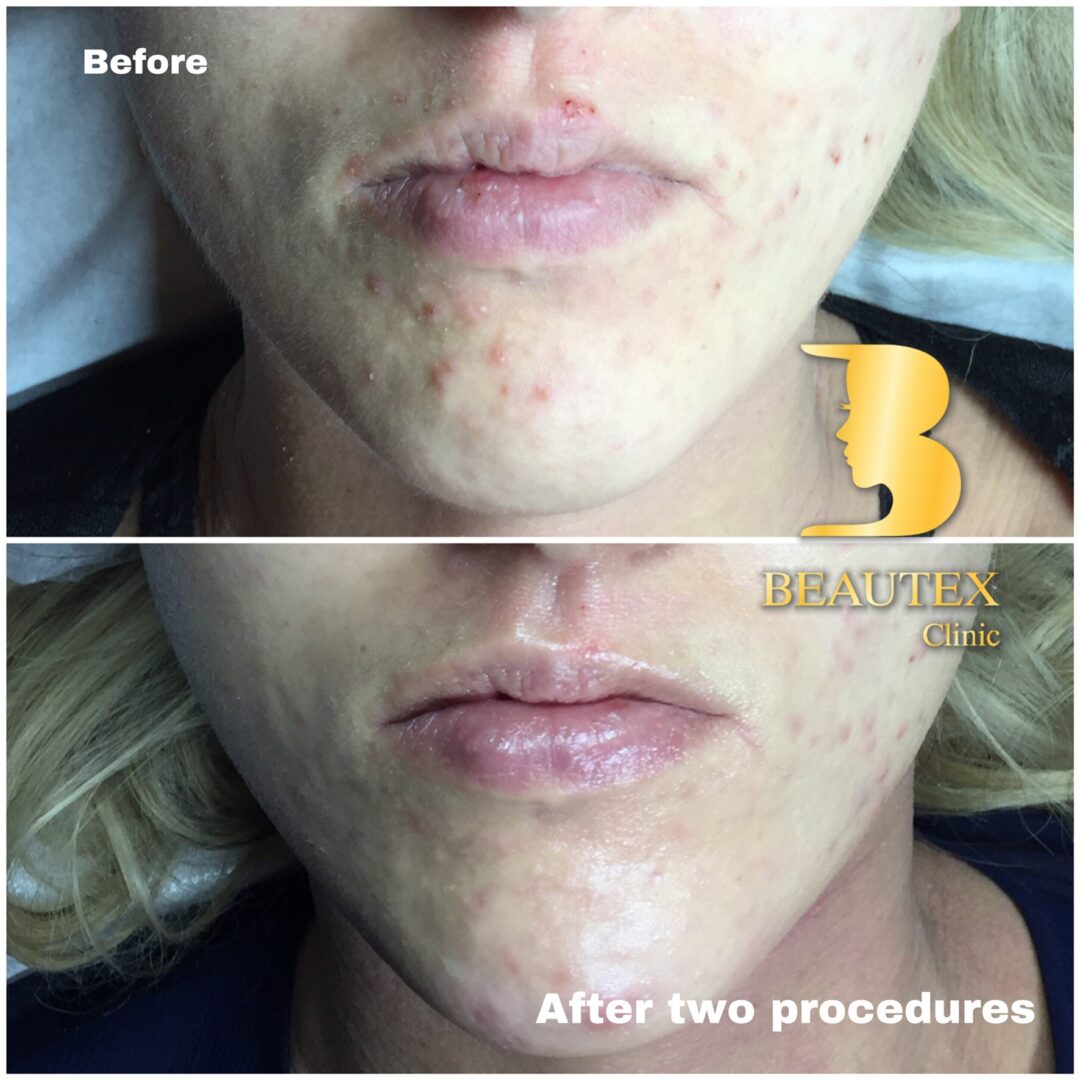 A woman's face before and after two procedures.